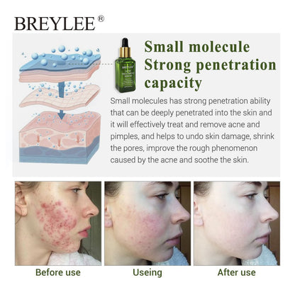 BREYLEE Suero Facial para el Tratamiento del Acné – Crema Facial Antiacné – Crema para Eliminar Cicatrices de Acné – Cuidado de la Piel – Blanqueadora y Reparadora – Eliminador de Espinillas para el Acné