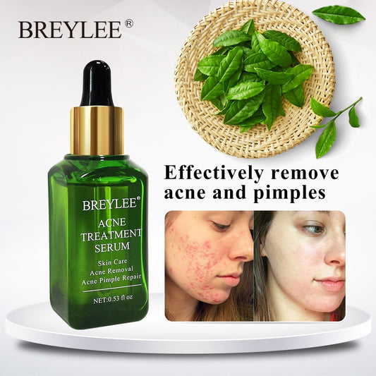 BREYLEE Suero Facial para el Tratamiento del Acné – Crema Facial Antiacné – Crema para Eliminar Cicatrices de Acné – Cuidado de la Piel – Blanqueadora y Reparadora – Eliminador de Espinillas para el Acné