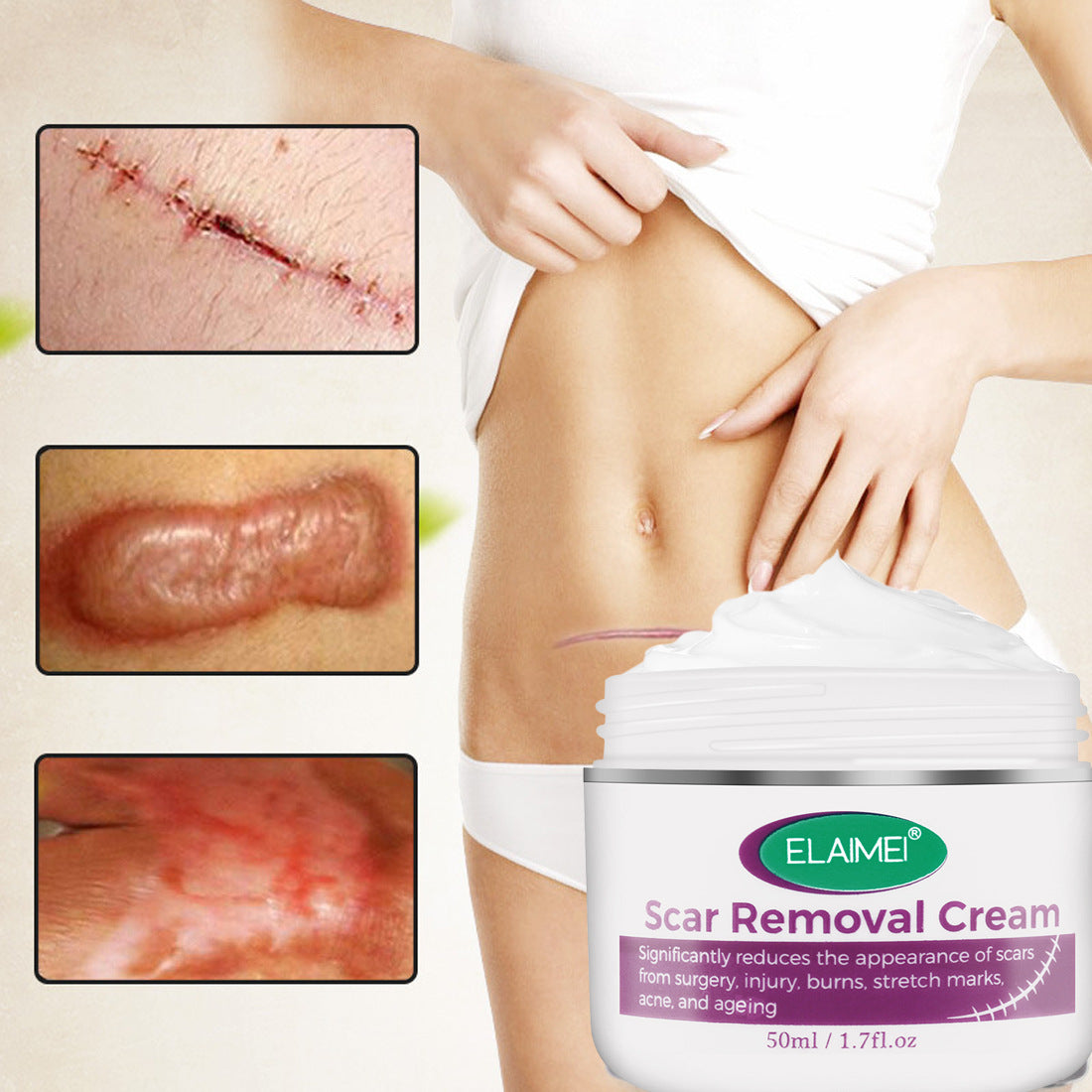 Crema para el acné sin cicatrices
