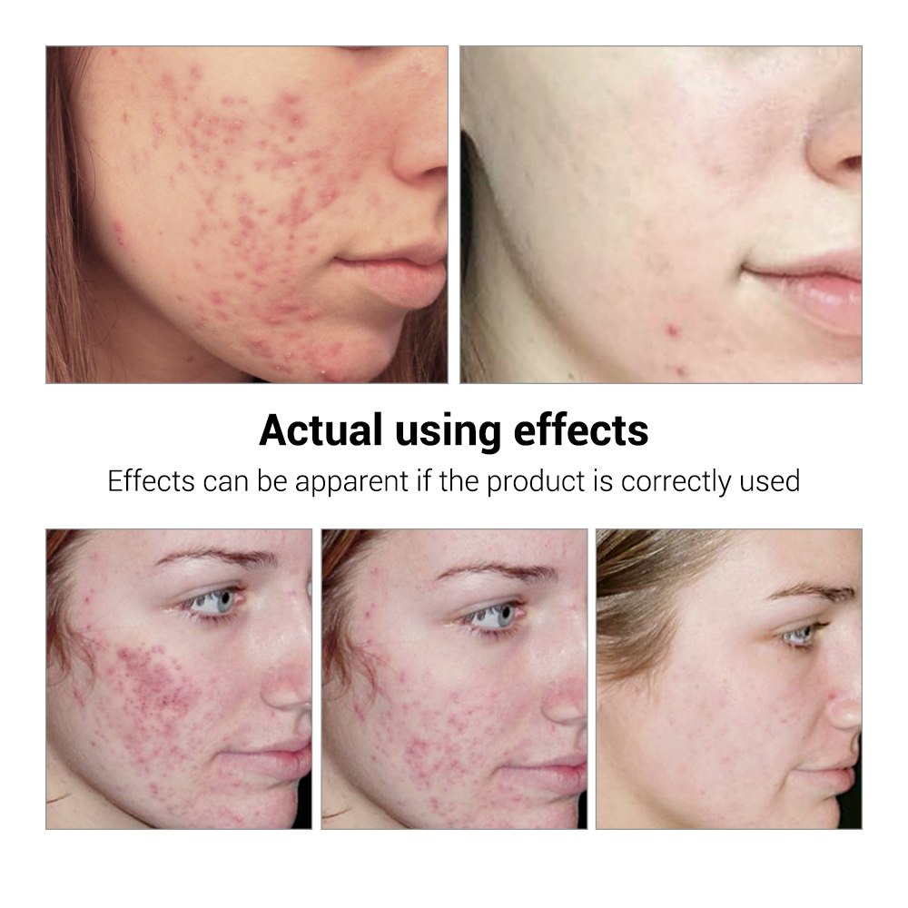 Suero Facial para el Tratamiento del Acné.